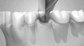 Dental edentation