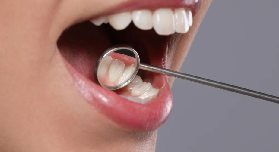 tratament endodontic tratament de canal clinica stomatologica Bucuresti