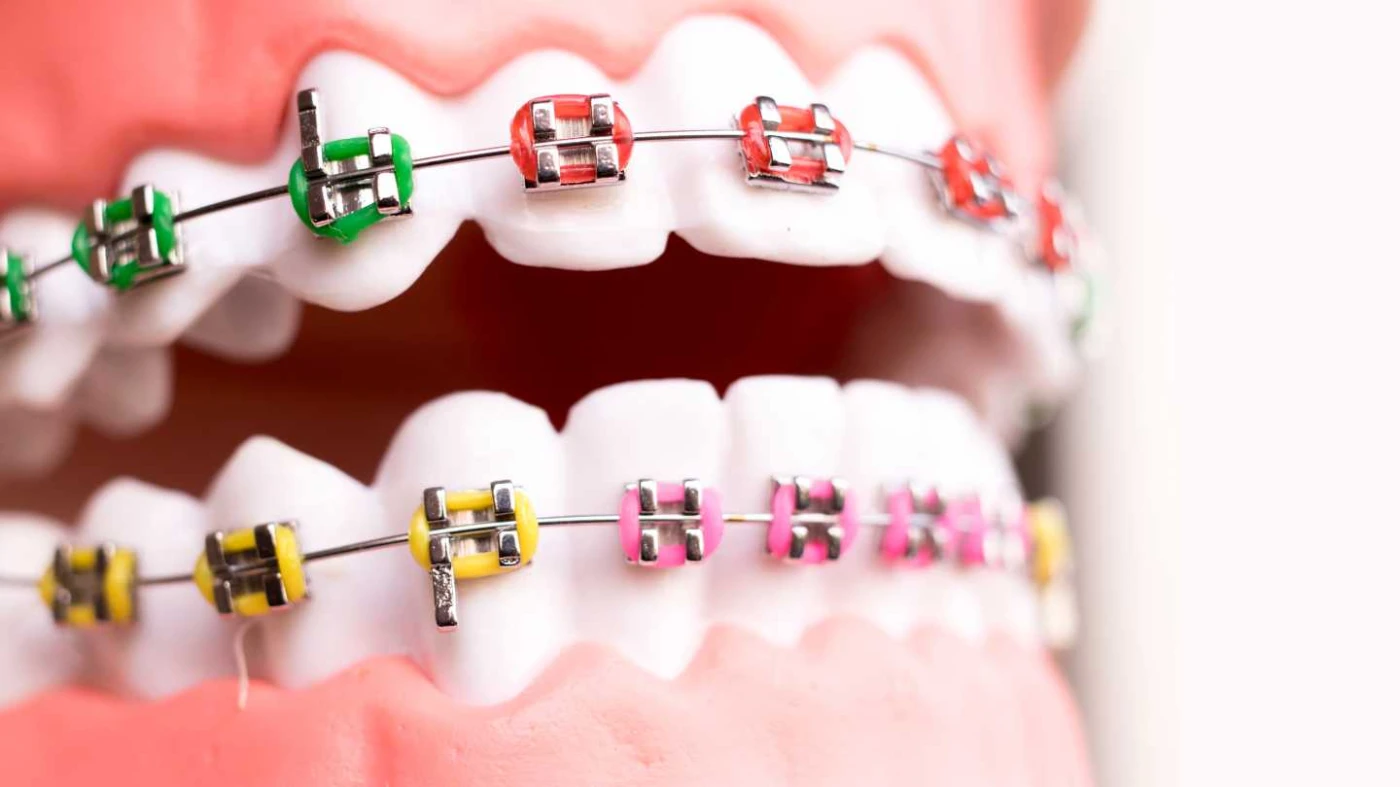 recolare bracket aparat dentar tratament ortodontic Bucuresti