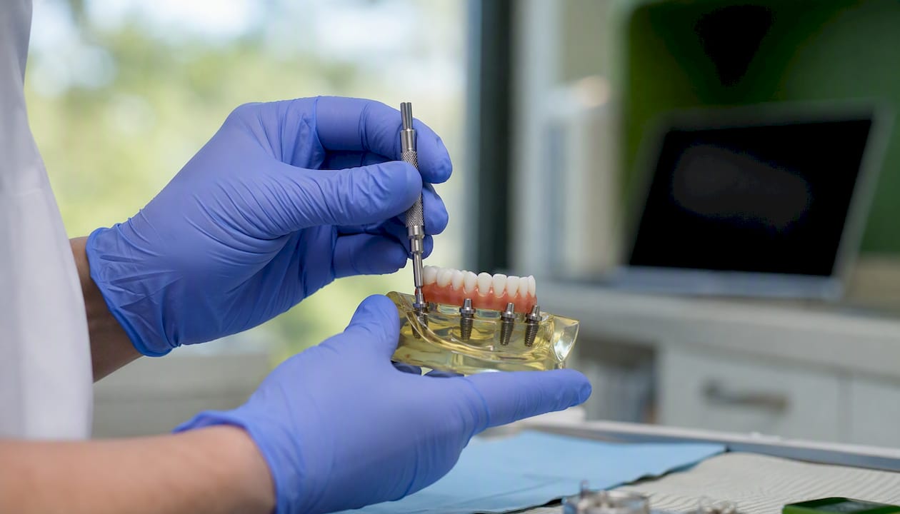 Cât costă reabilitarea orală completă în România: ghid de prețuri 2 Mâinile fixează un instrument pe un model de implant dentar All-on-4