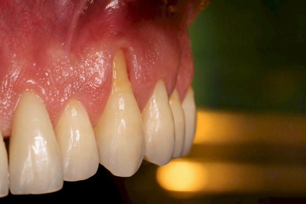 Retracție gingivală cu expunerea rădăcinii