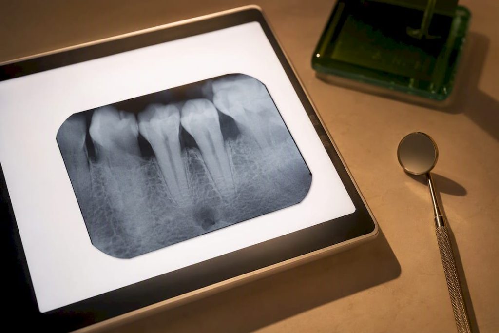 Radiografie dentară cu semne de leziune apicală