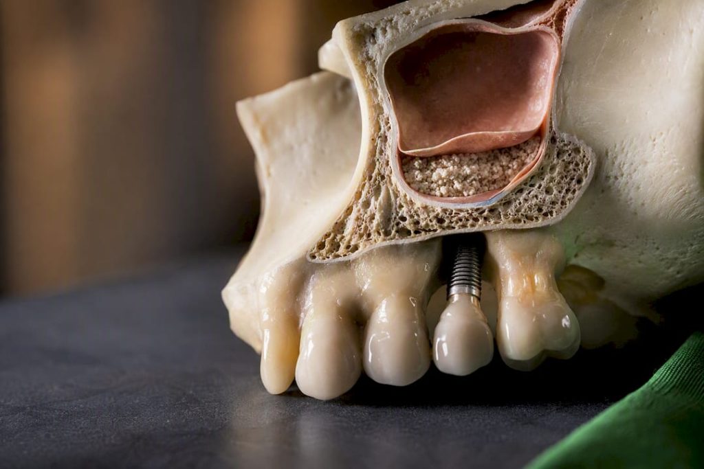Model anatomic pentru augmentarea sinusului maxilar